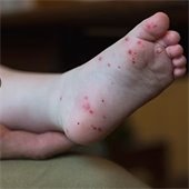 Child's foot with Hand Foot and Mouth Disease rash