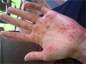 hand with blisters from hand foot and mouth disease