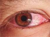 Eye with a pinkeye infection