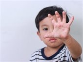 Child with rash on hand
